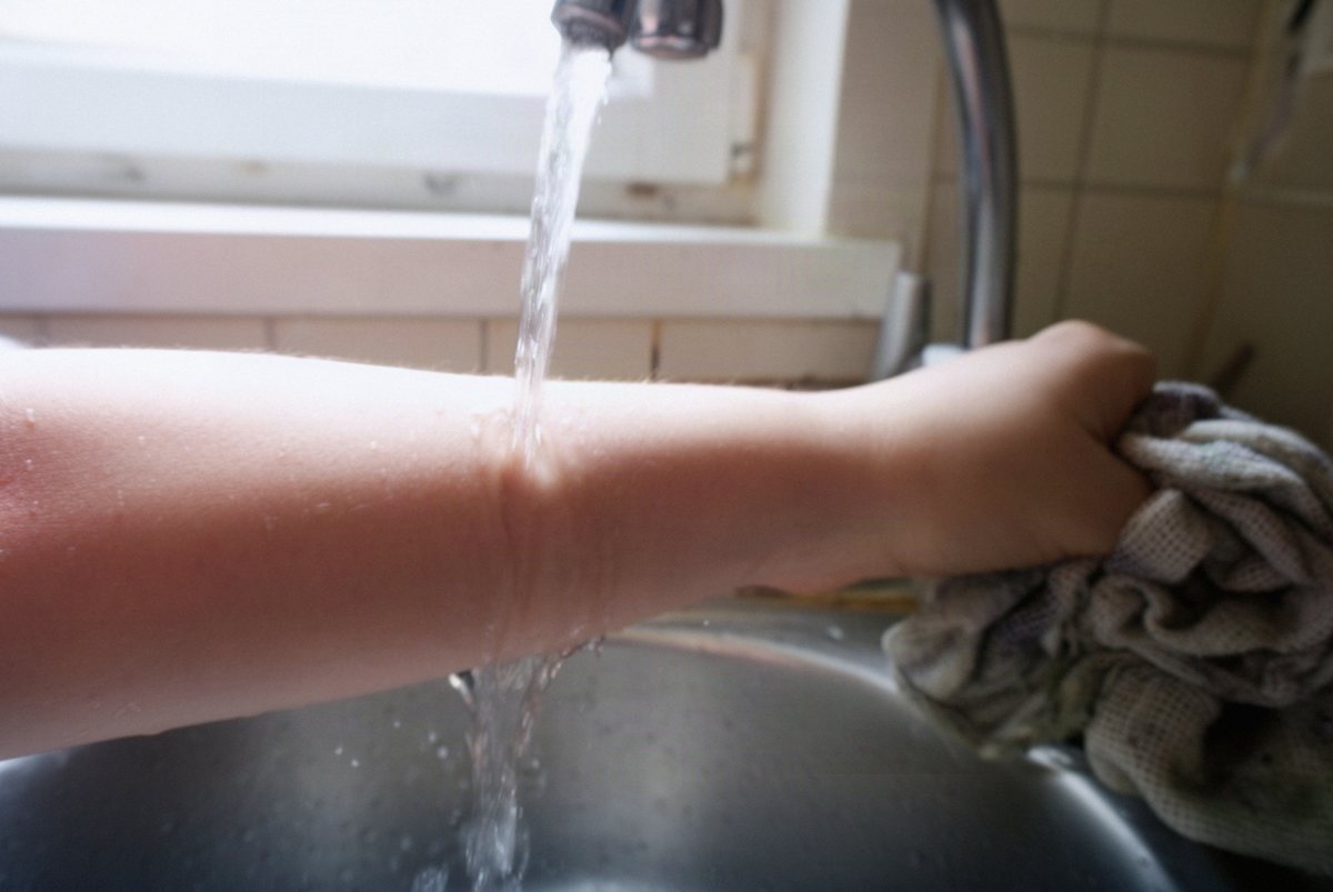 Oparzenie chemiczne skóry: objawy i pierwsza pomoc